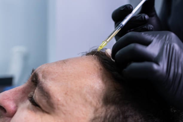 علاج PRP للشعر في الرياض