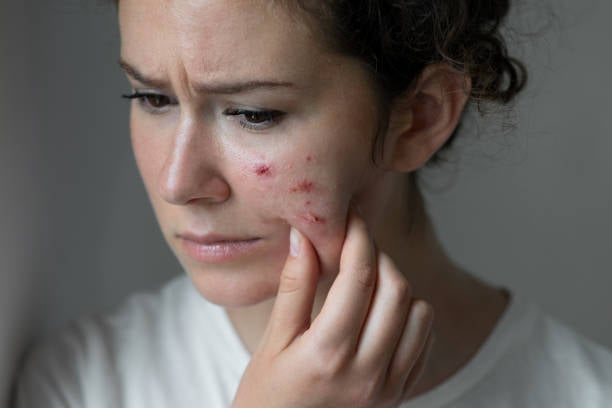 Pimples Treatment in Riyadh