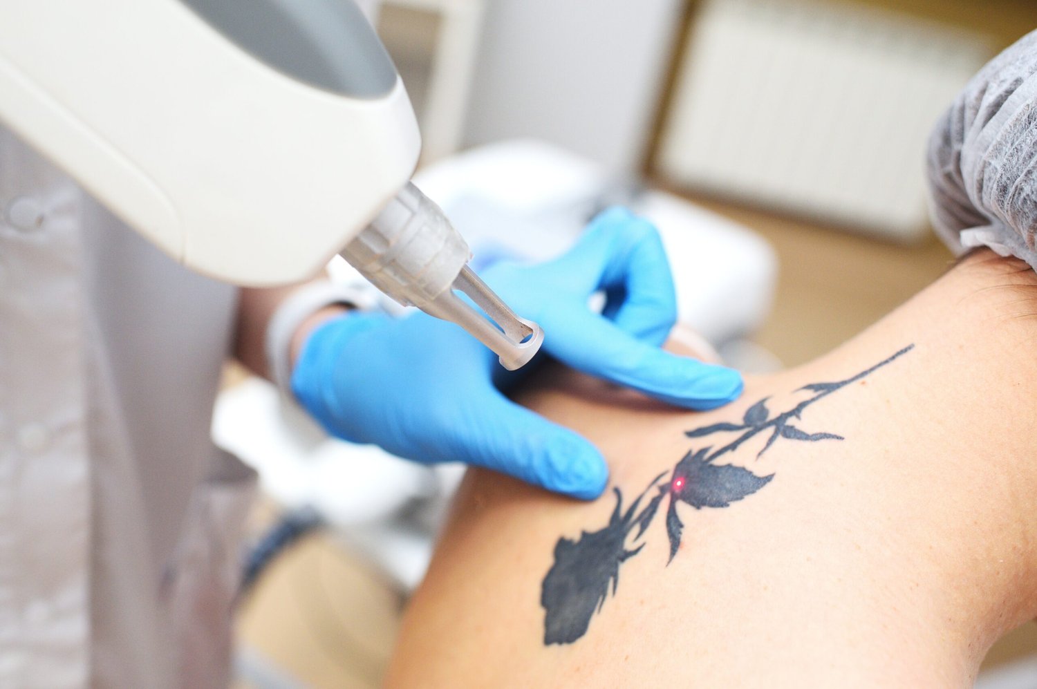 Laser Tattoo Removal in Riyadh