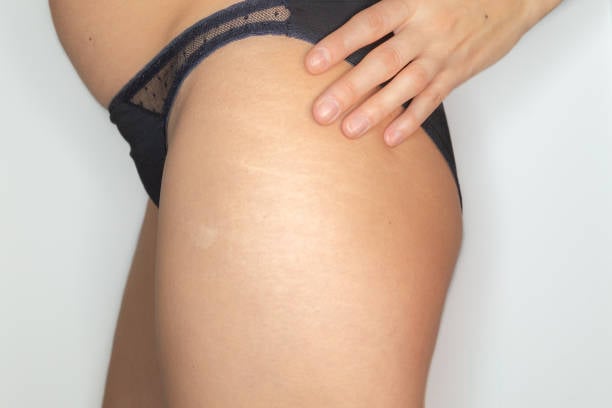 إزالة علامات التمدد في الرياض