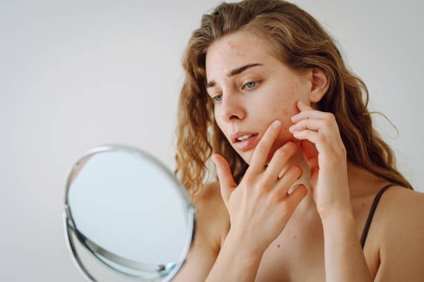 Pimples Treatment in Riyadh