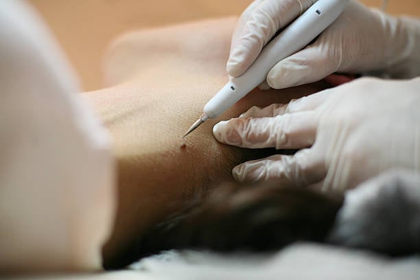 Skin Tag Removal in Riyadh