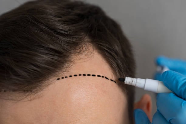 How much does 5000 grafts Hair Transplant Cost in Riyadh?