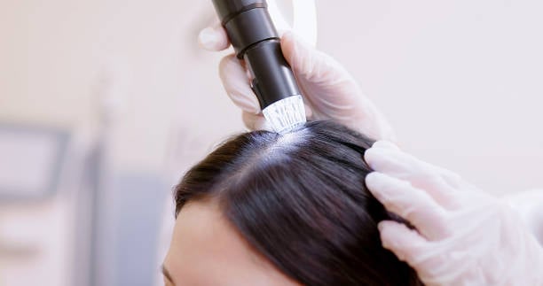 Hair Loss Treatment in Riyadh