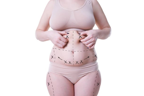 Lipo Abdominoplasty in Riyadh