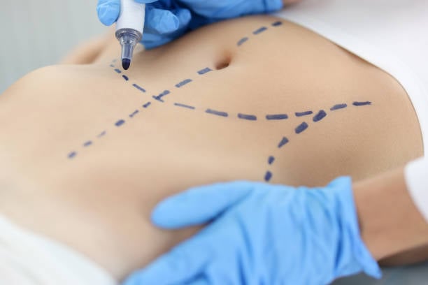 Liposuction in Riyadh