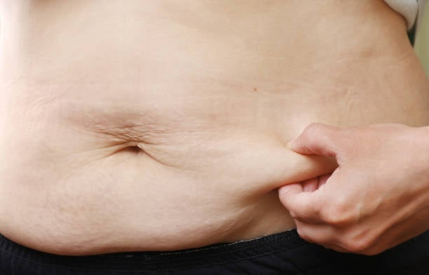 Tummy Tuck in Riyadh