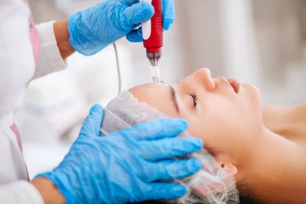 Laser Acne Scar Treatments in Riyadh