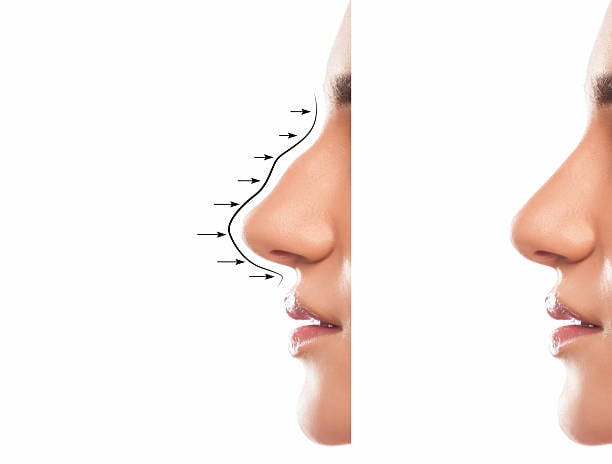 Hiko Nose Lift Cost in Riyadh
