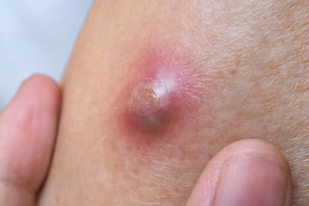 Sebaceous Cyst Removal Cost In Riyadh