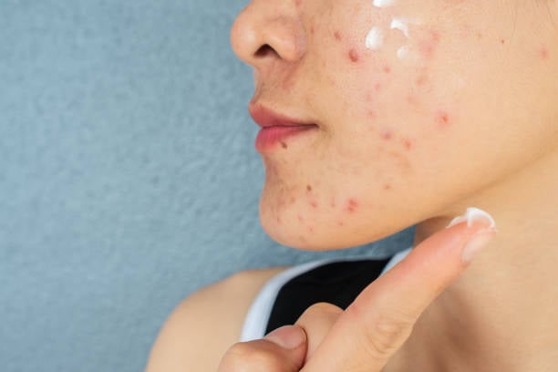 Acne Treatment in Riyadh