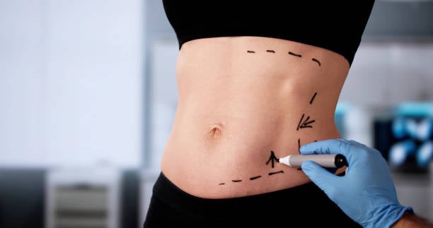 Liposuction in Riyadh