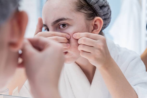 Acne Treatment in Riyadh