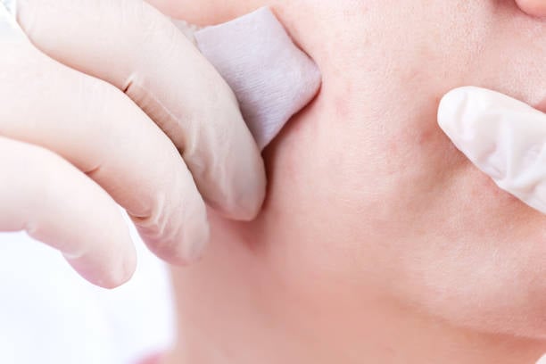 Buccal Fat Removal in Riyadh