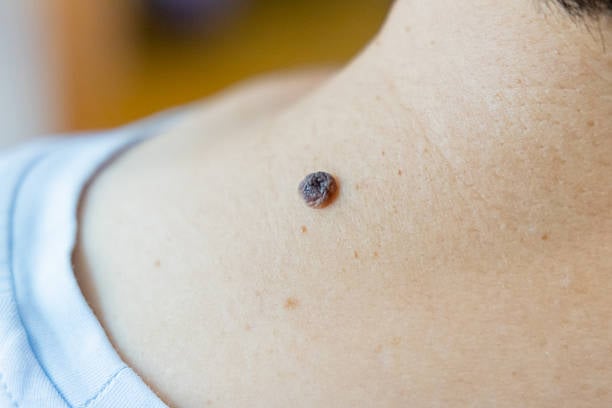 Mole Removal in Riyadh