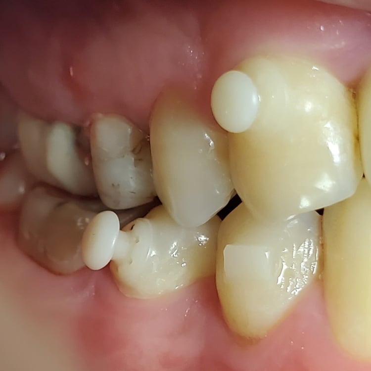 Invisalign Buttons