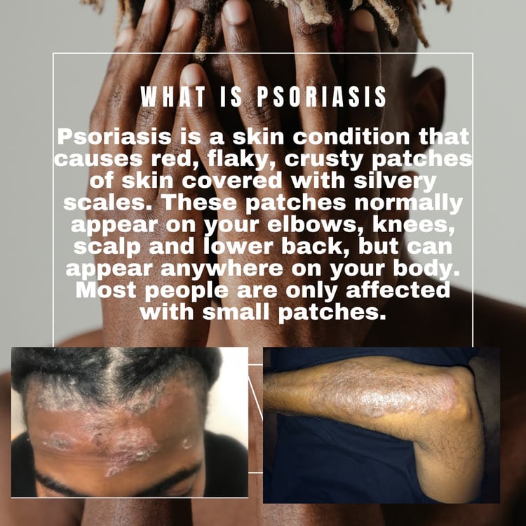 Psoriasis on the scalp and skin.