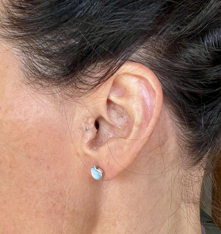 Ear reflexology (auricular therapy) in Kerikeri