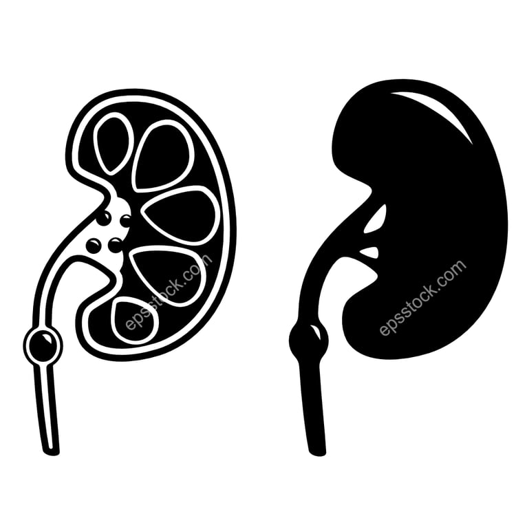 Kidney stones