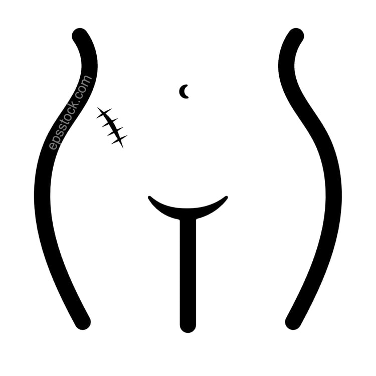 appendicitis scar