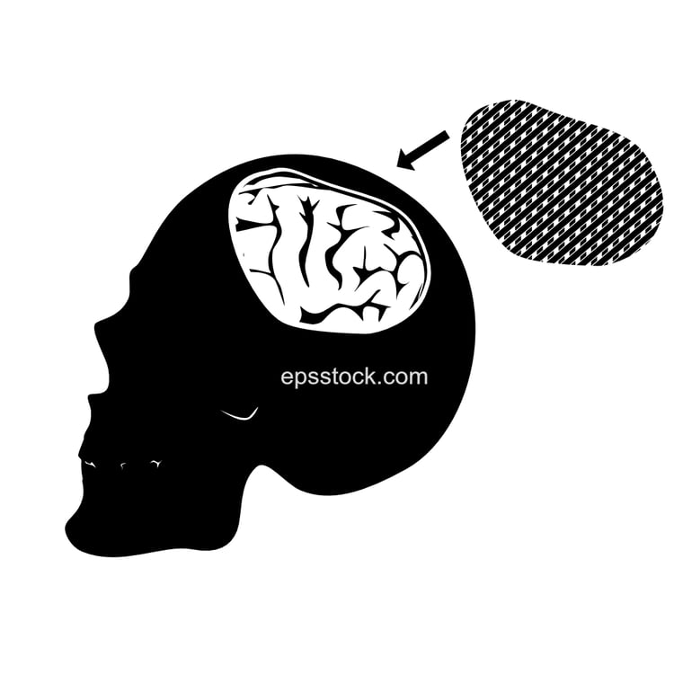 skull with a titanium mesh