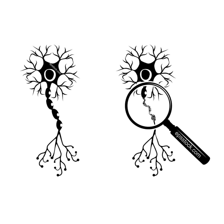 Demyelination of neuron sheath
