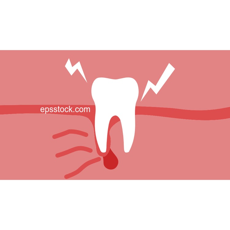 tooth Root Infection