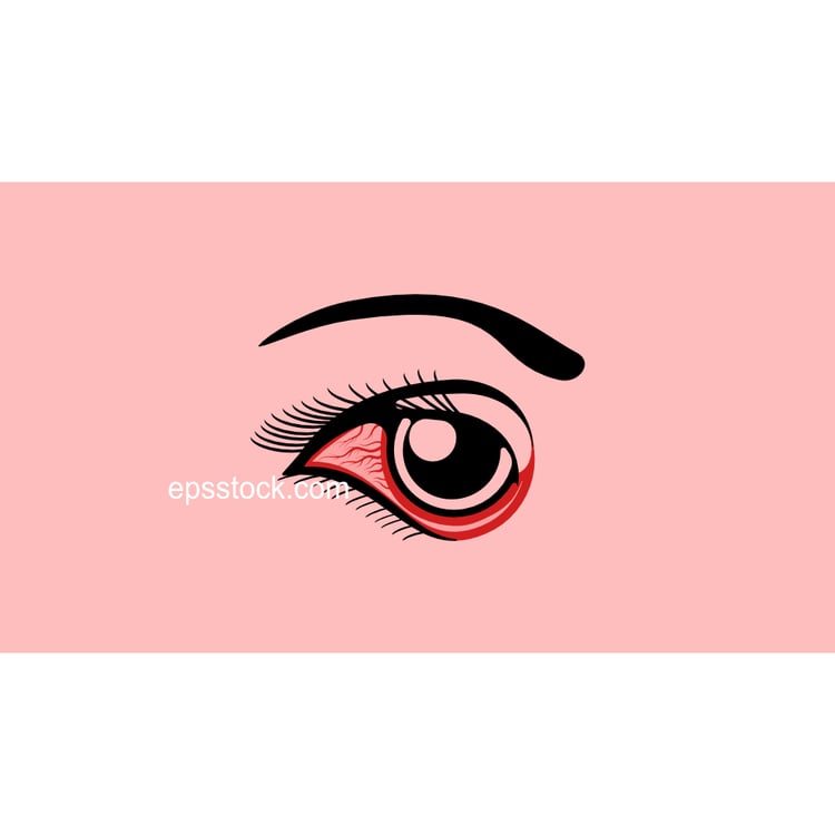 Conjunctivitis,  pink eye