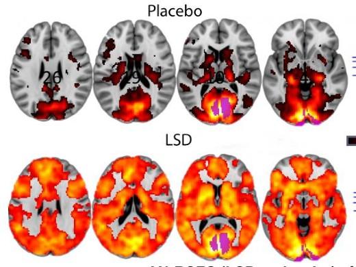 the difference in brain activity in a normal state and in a state under LSD