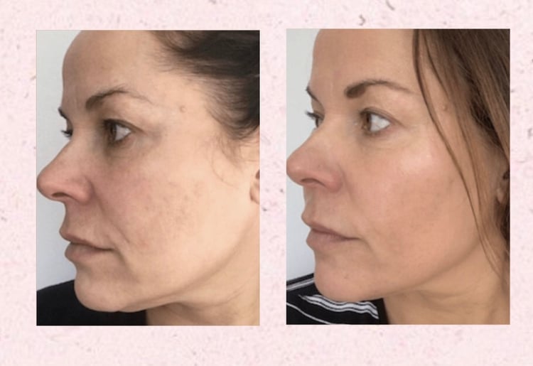 Face transformation with face yoga massages sharper jawline, snatched face, reduced double chin, reduce wrinkles