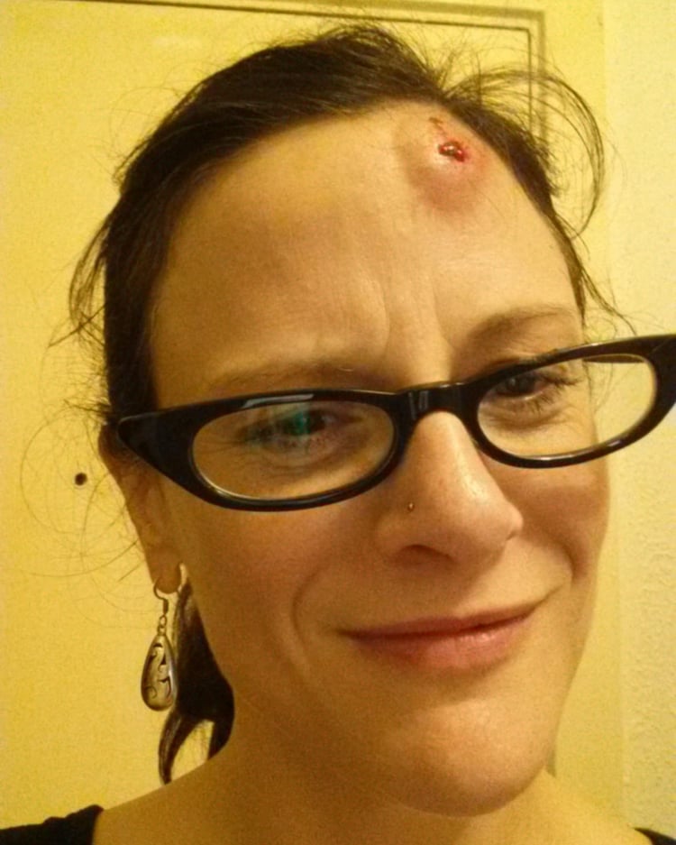 the bump on Colinda's head after walking into the pole