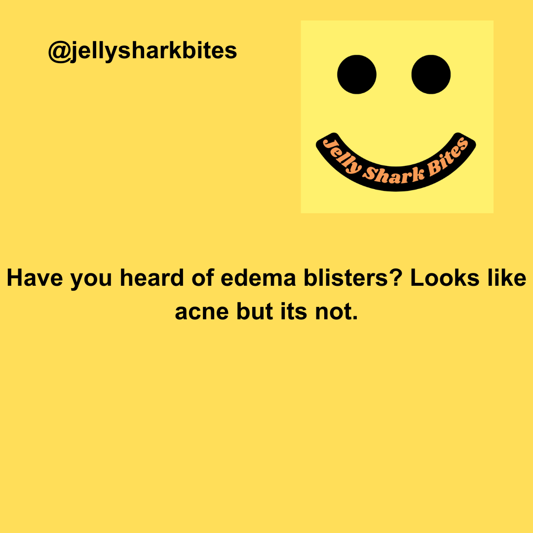 @jellysharkbites have you heard of edema blisters? Looks like acne but its not.