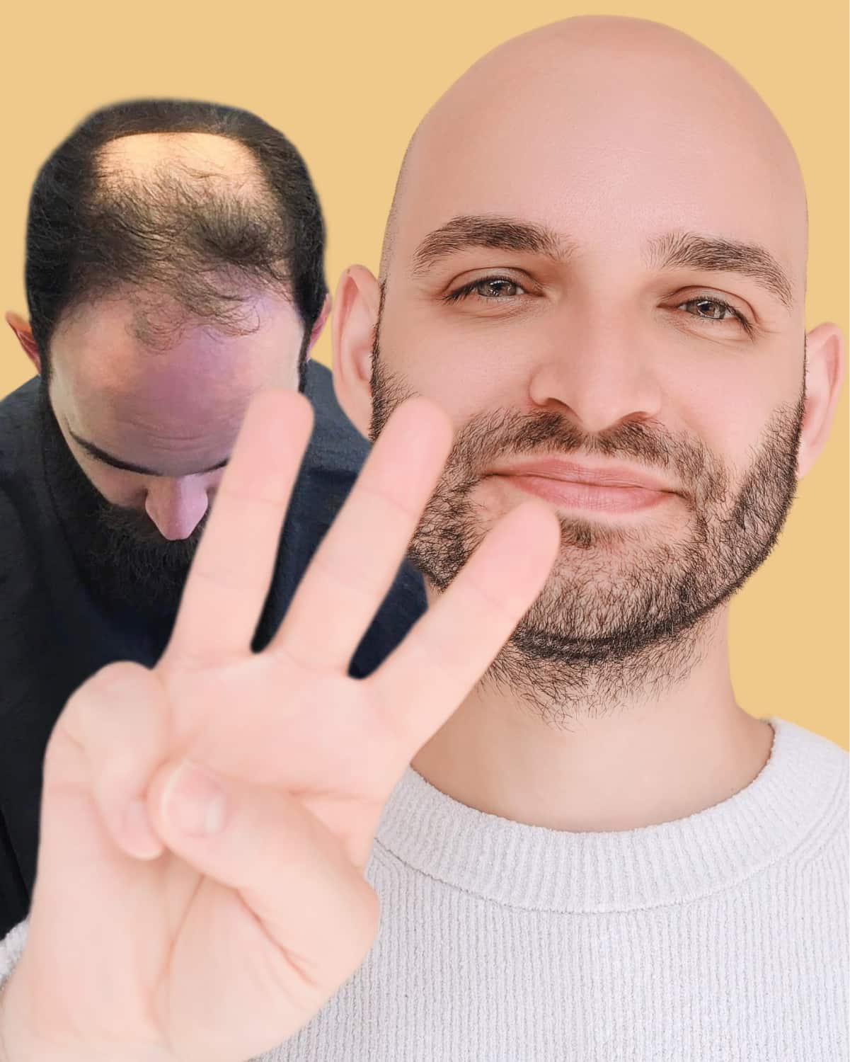Mann Vorher Nachher mit Haarausfall und Glatze
