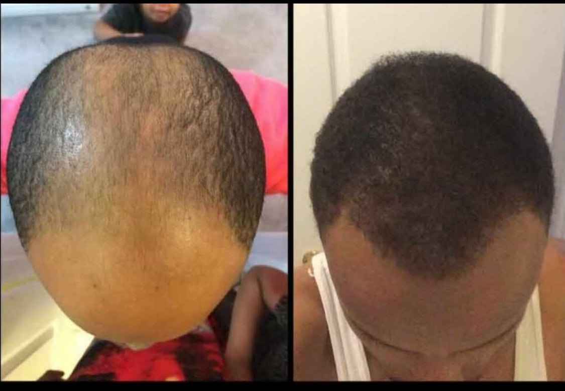 Biotin 10 000 mcg Maximum Strength High Potency 100 Tablets Hair Skin and Nails