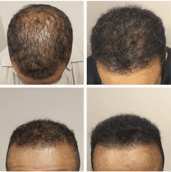 Biotin 10 000 mcg Maximum Strength High Potency 100 Tablets Hair Skin and Nails