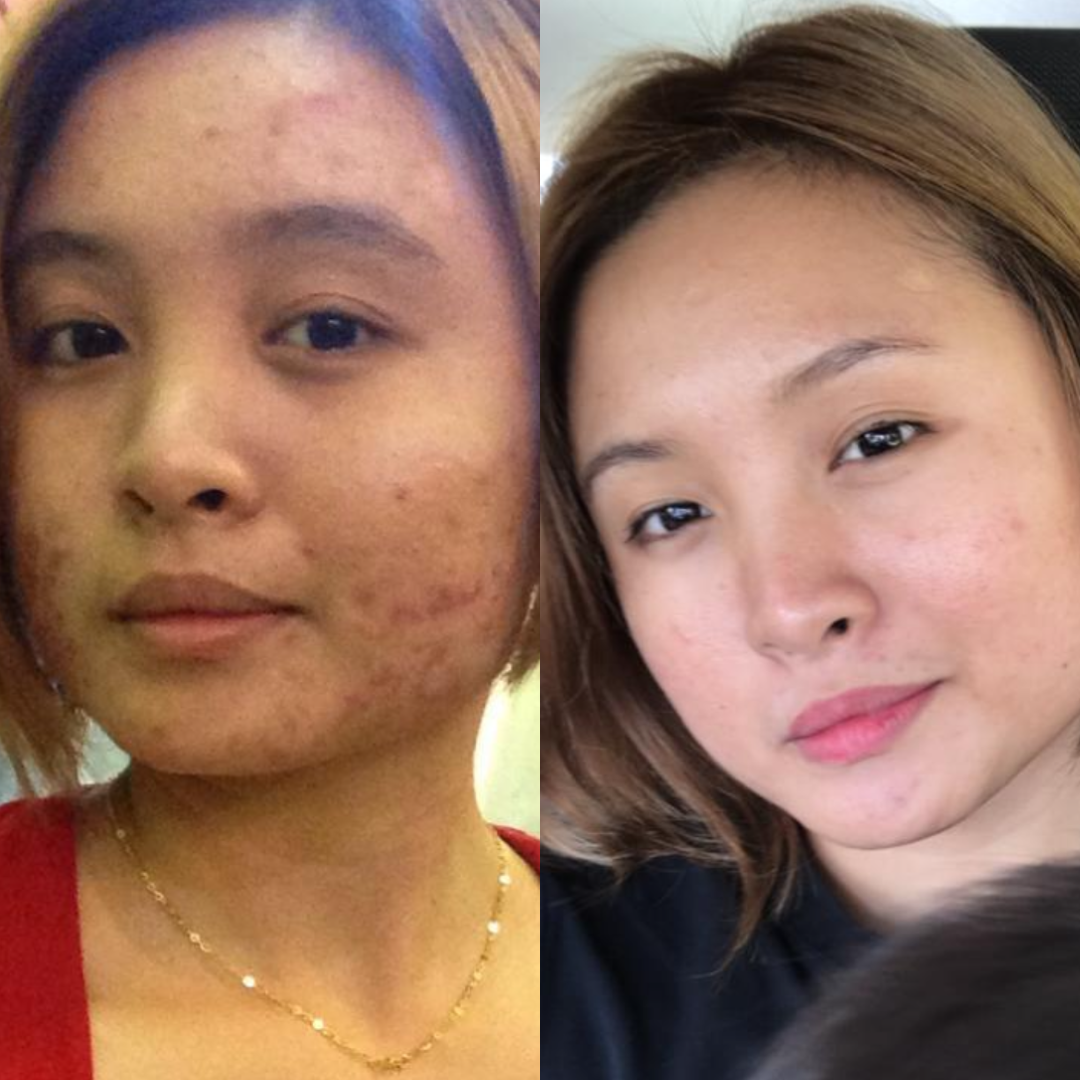 “After healing my barrier naturally — no more filters needed.”