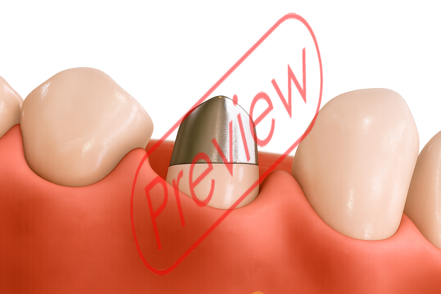 Huda Bridge Dental Figure 4160 Crown and Bridge - Payhip