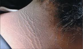 Skin Darkening – Acanthosis Nigricans (aka “Dirty Neck Syndrome”)