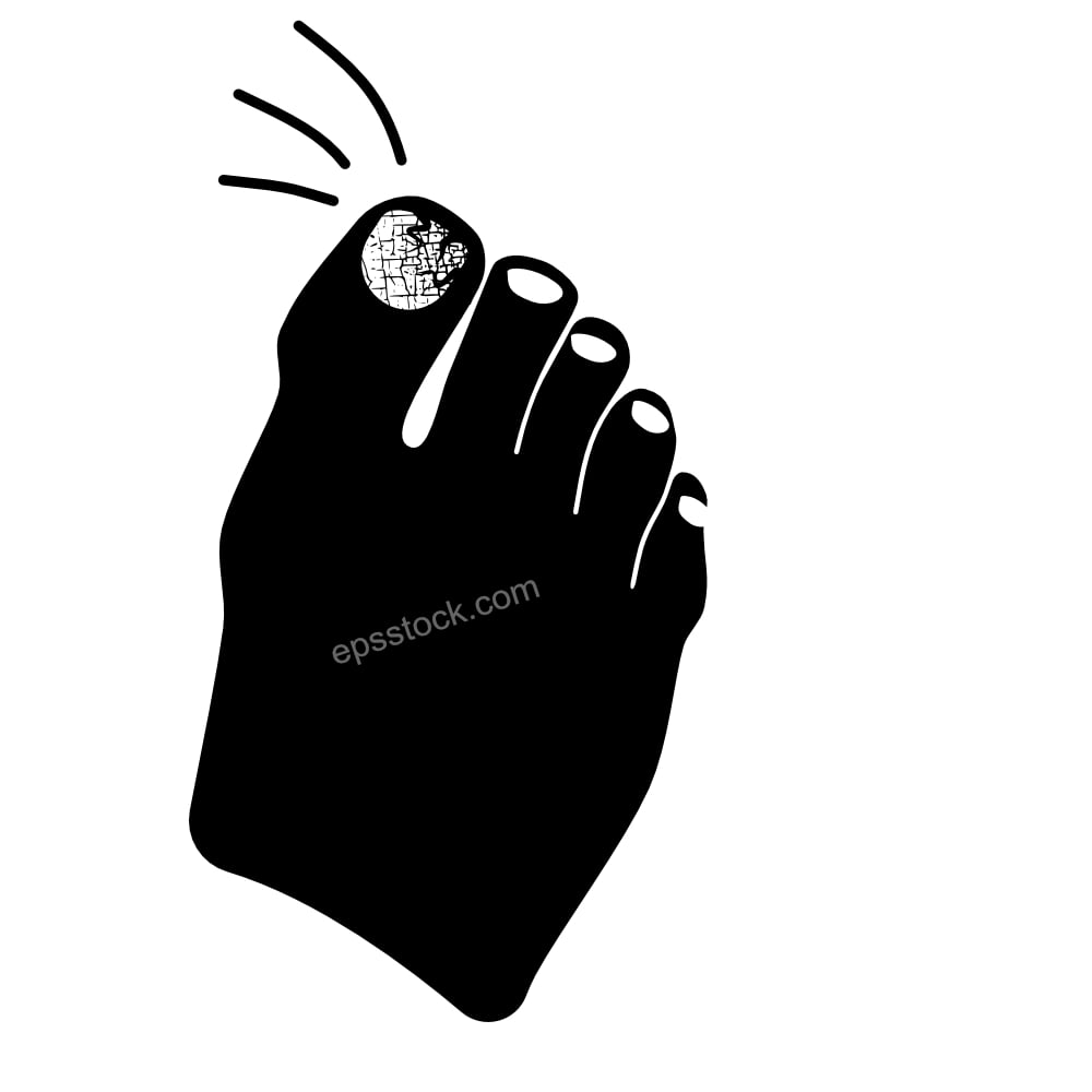 Fungal nail infection