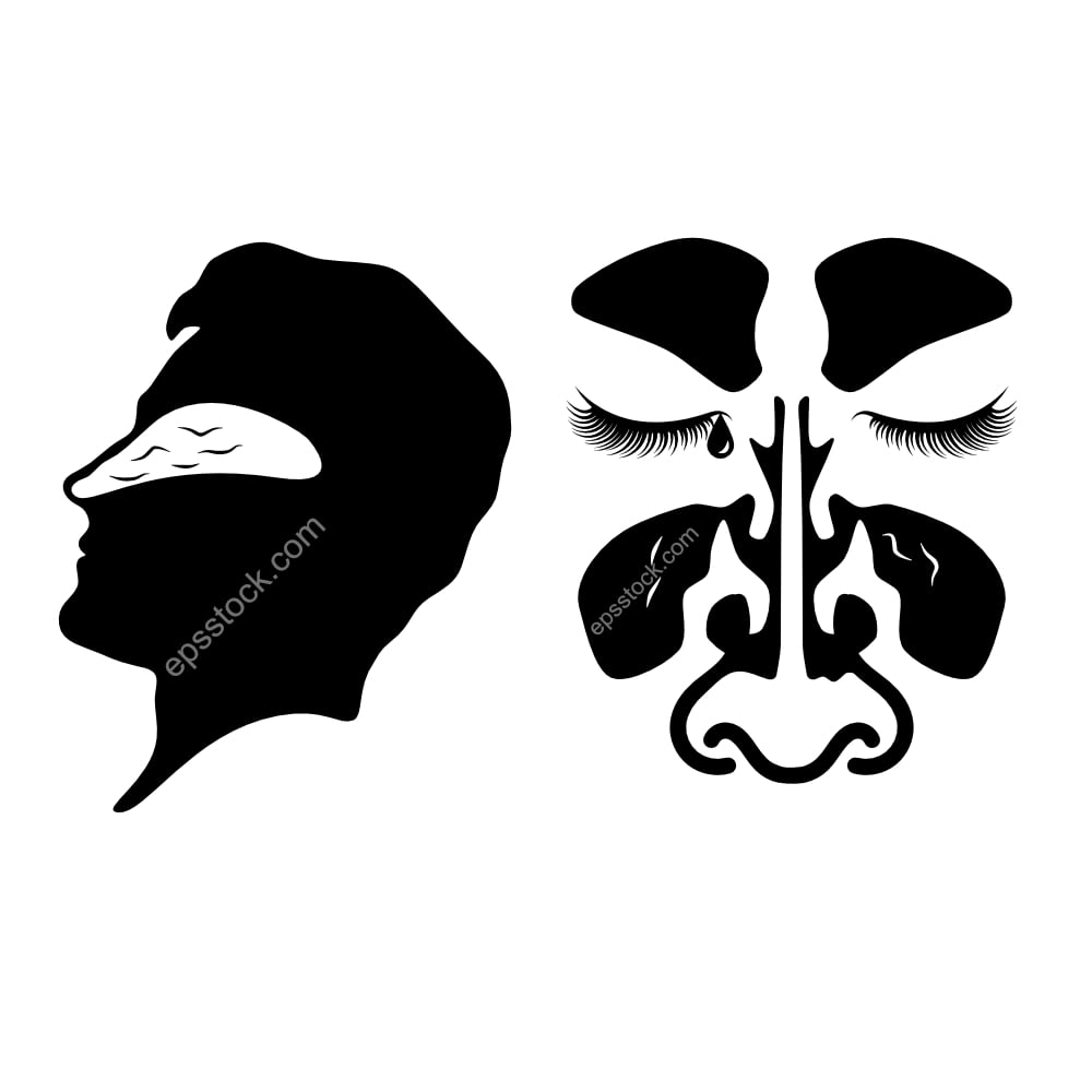 Allergic rhinitis