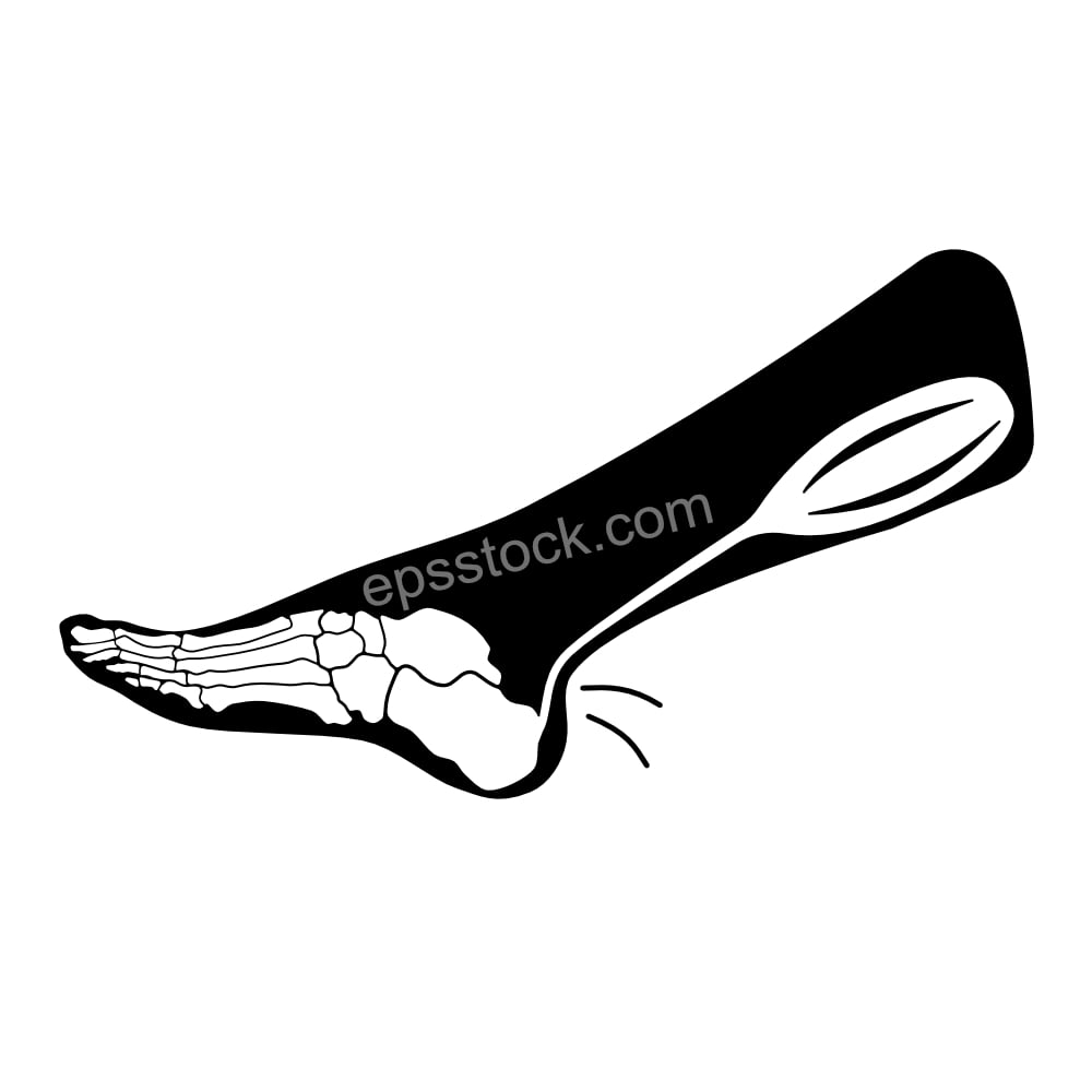 Achilles tendinopathy