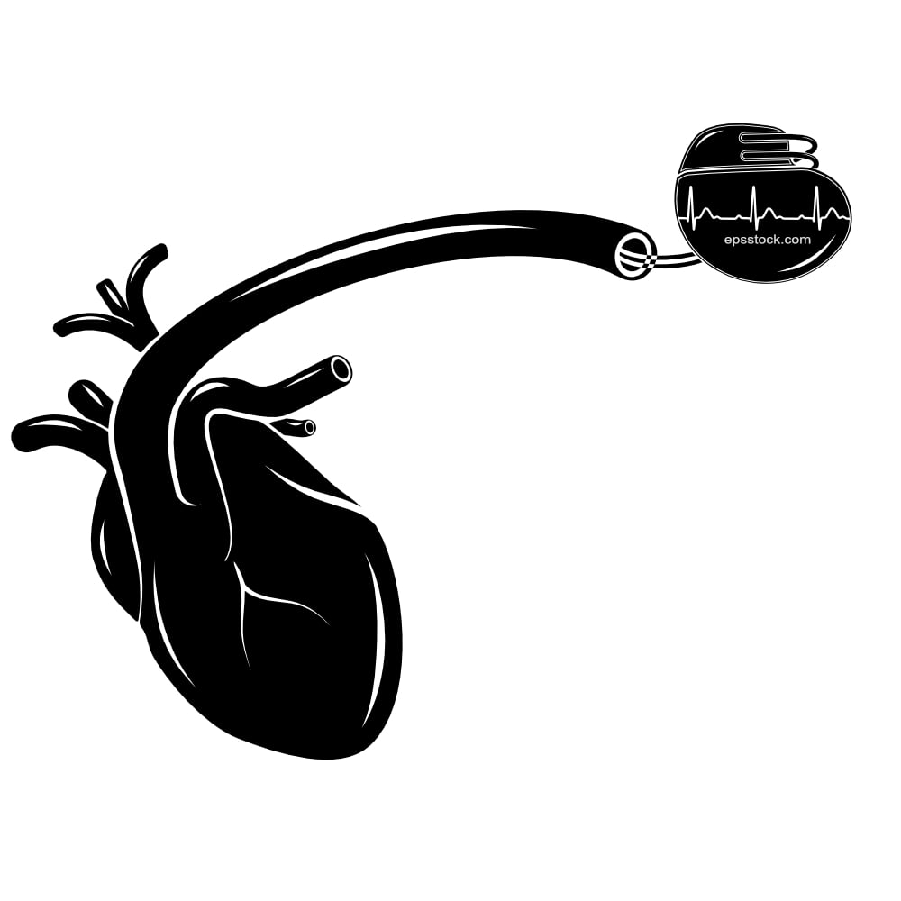 An artificial cardiac pacemaker implanted in the heart