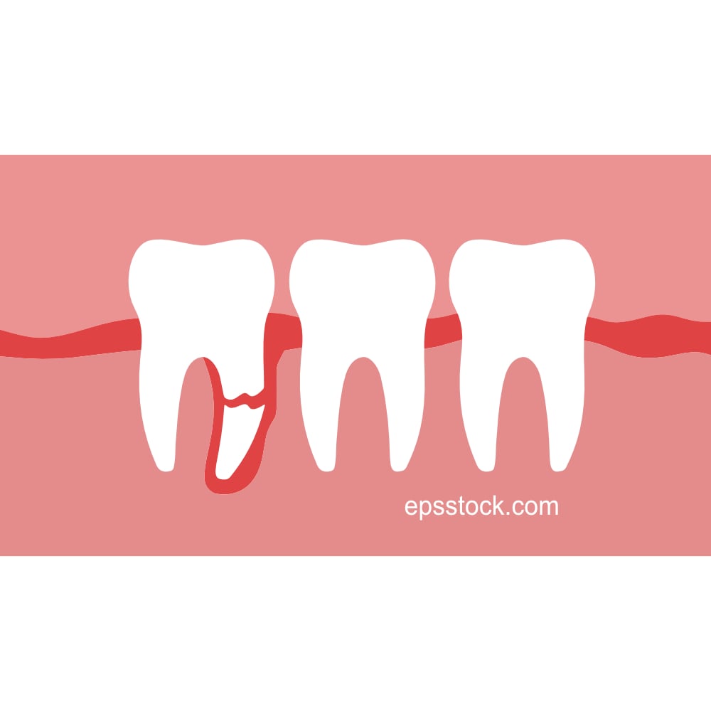 broken wisdom tooth root