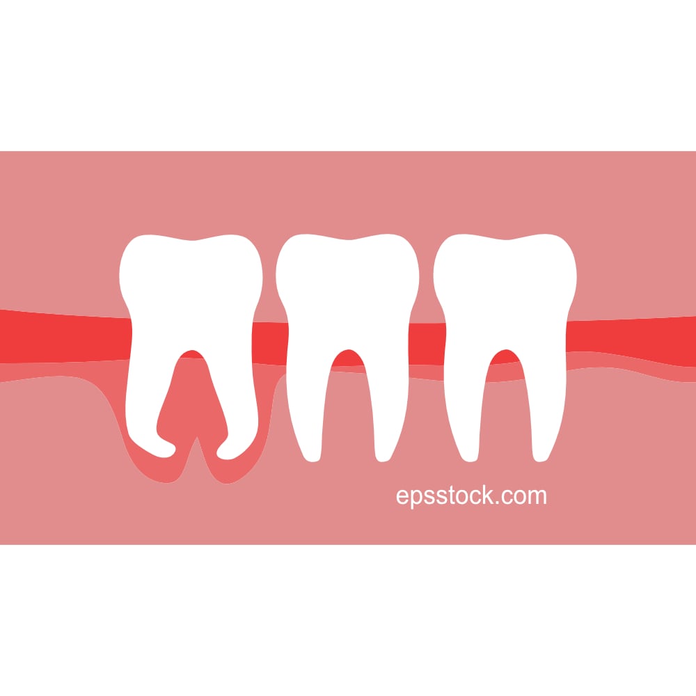 Hooked wisdom tooth root