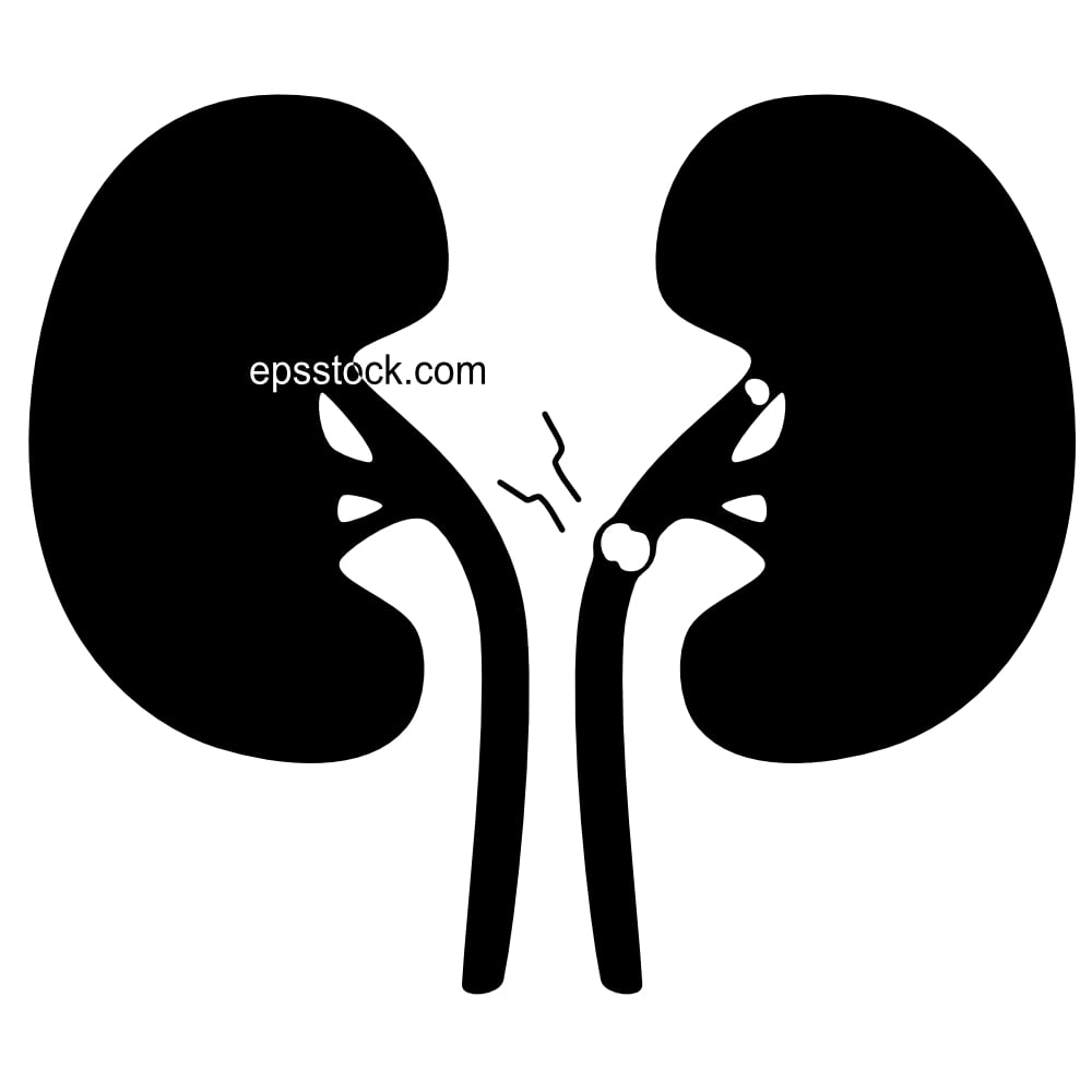 kidney stones