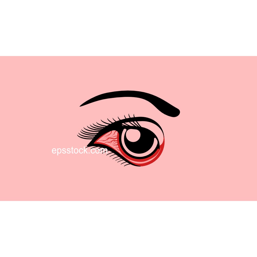 Conjunctivitis,  pink eye
