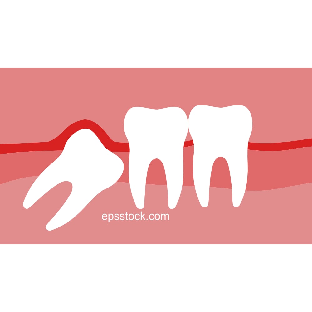 A wisdom tooth grows