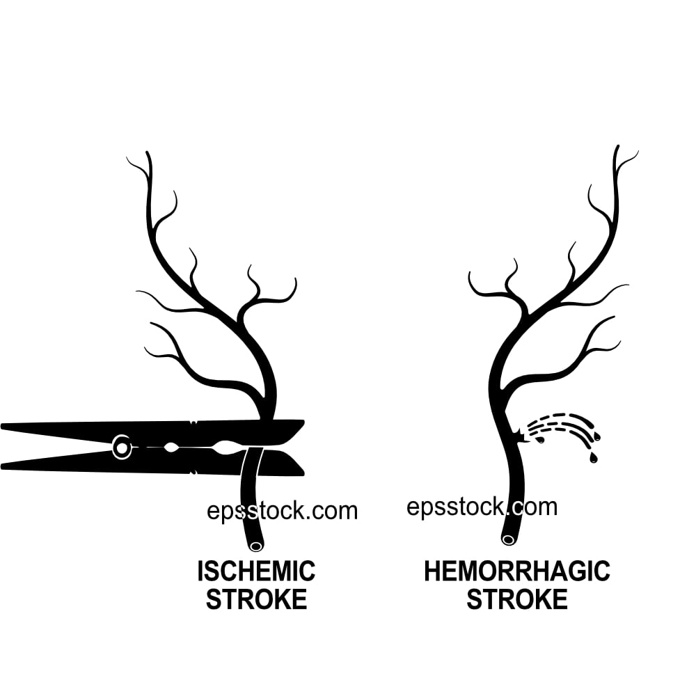 Different Types of Stroke