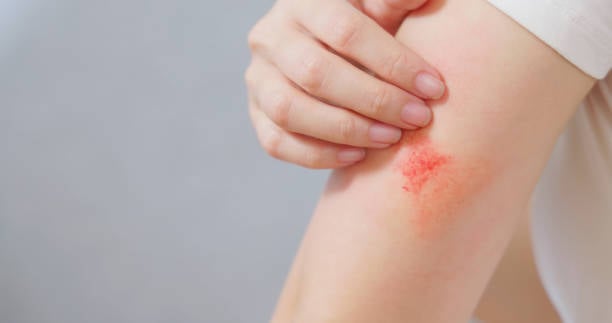 Skin lesion Removal in Riyadh