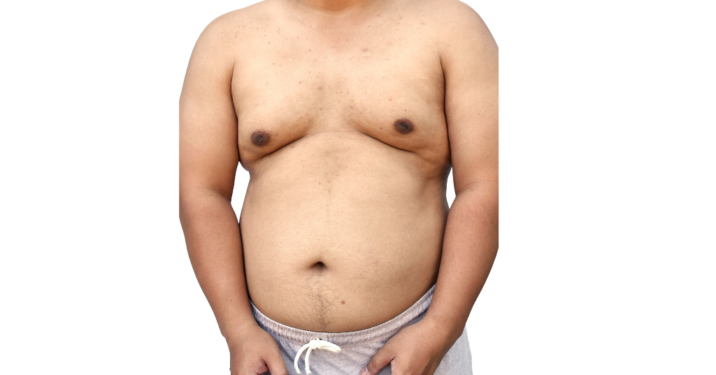 Gynecomastia Surgery in Riyadh